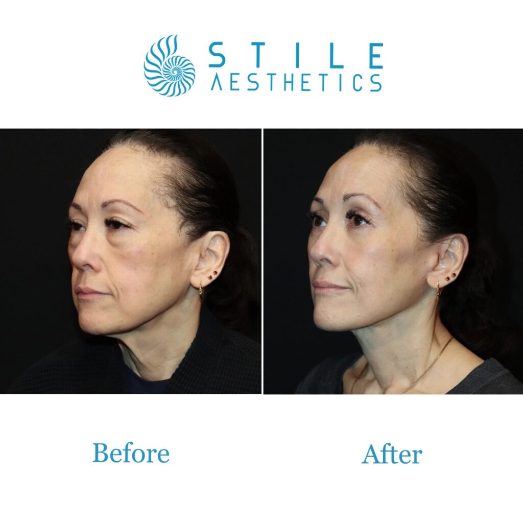 Patient Reviews Reveal Real Satisfaction Rates Across Facelift Technique